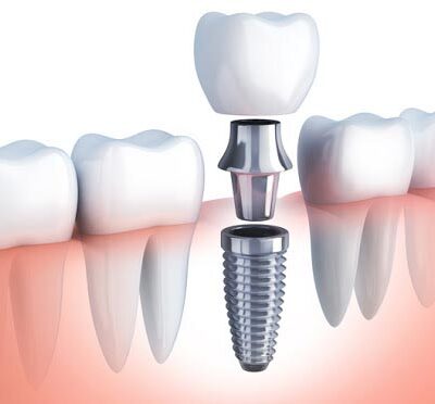 preparation-mettalographique-medical-implant-dent